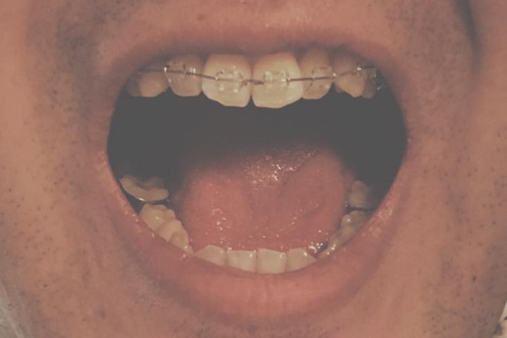 braces4-featured-image